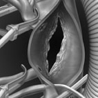thoracoabdominal aortic aneurysm