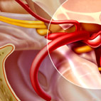 anterior choridal artery